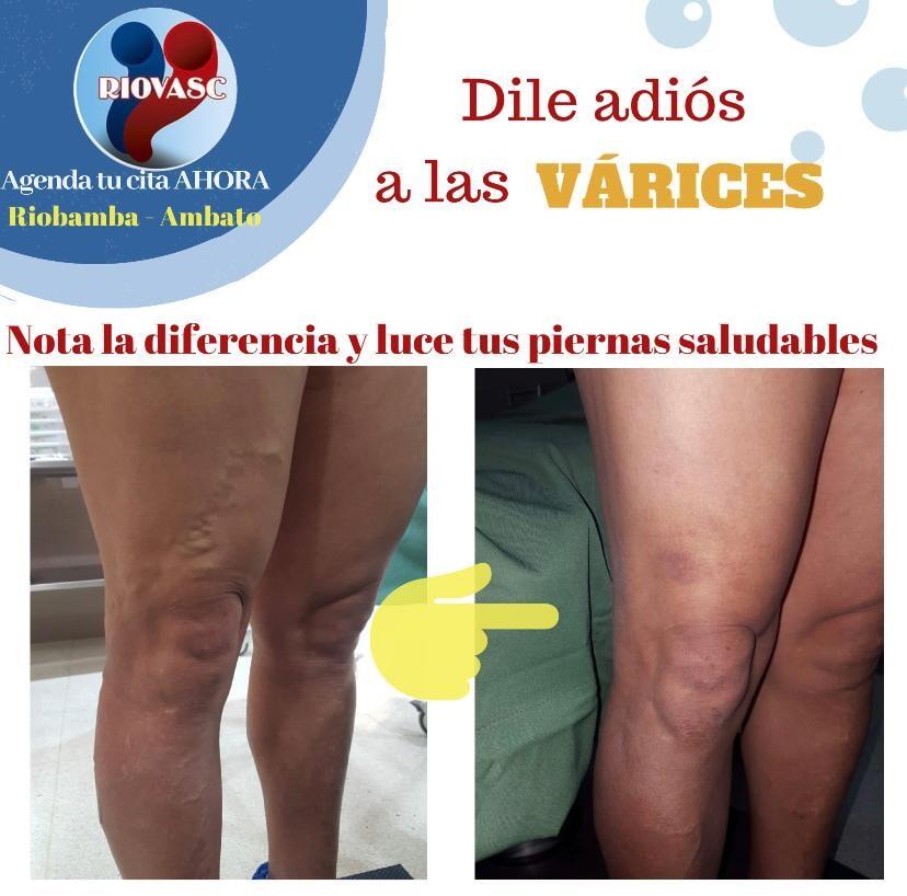 varices riobamba